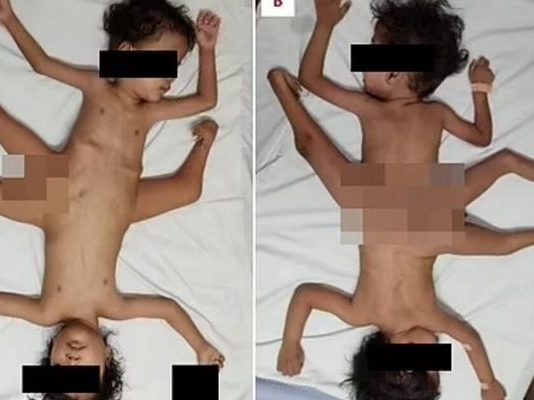 Ινδονησία: Γεννήθηκαν «σιαμαία αράχνες» με τρία πόδια, τέσσερα χέρια και ένα πέος